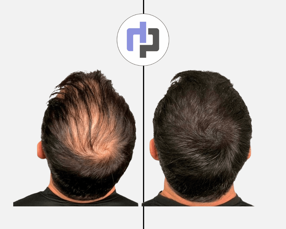 calvitie homme tricopigmentation