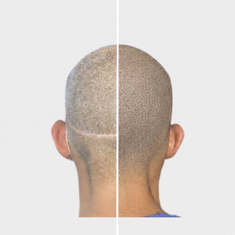 camouflage cicatrice tricopigmentation