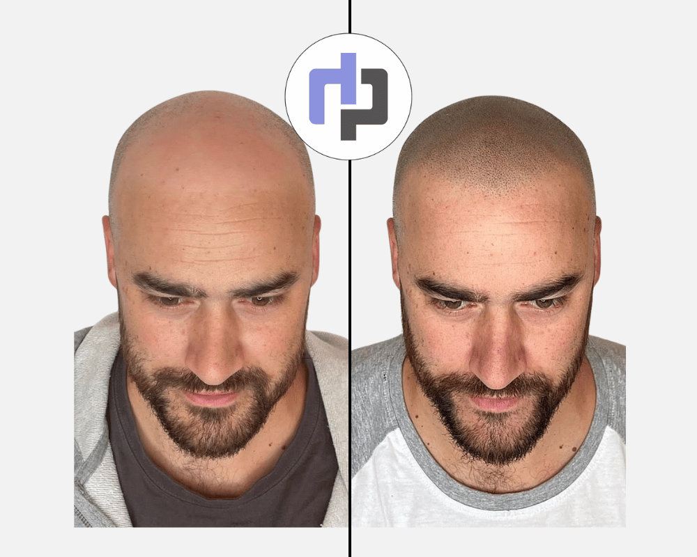 crane rasé tricopigmentation