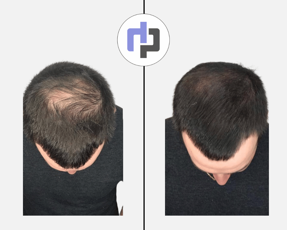 homme calvitie solution