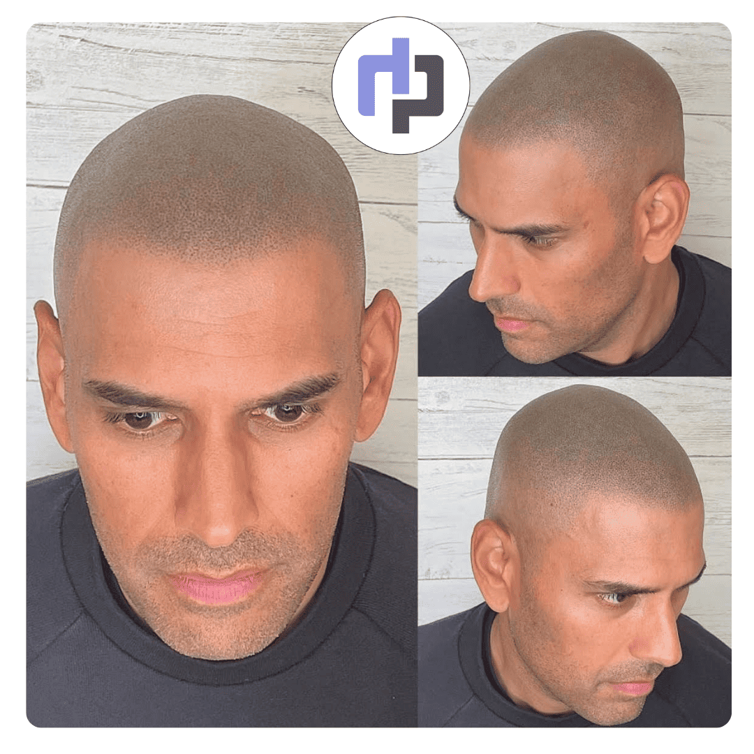 tricopigmentation bordeaux crane rasé