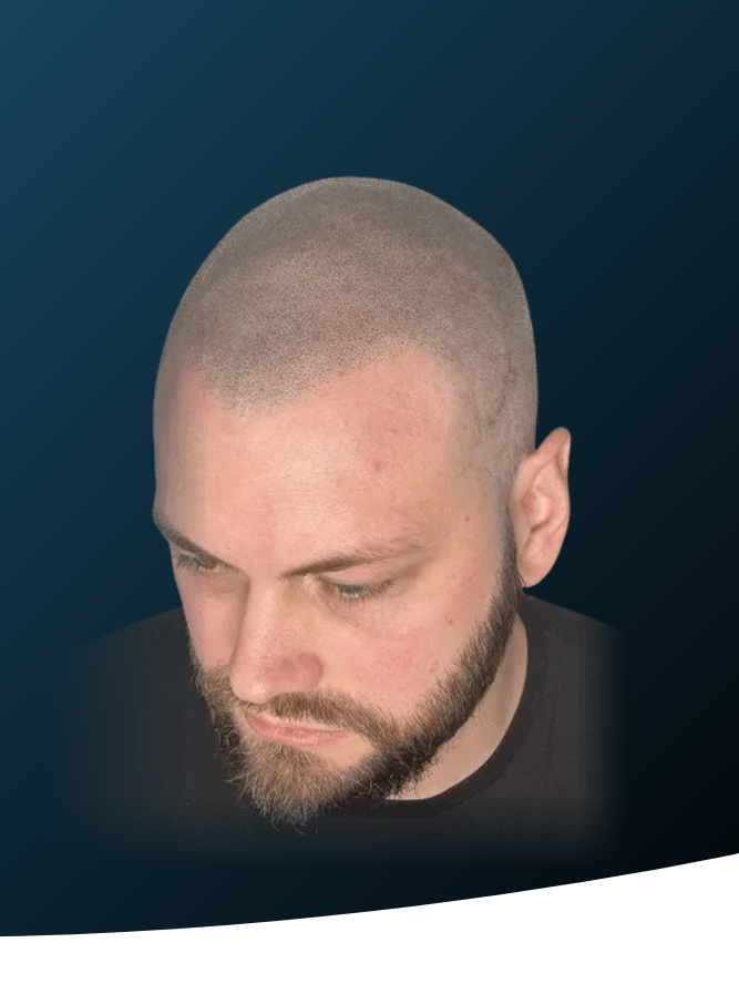 tricopigmentation crane rasé