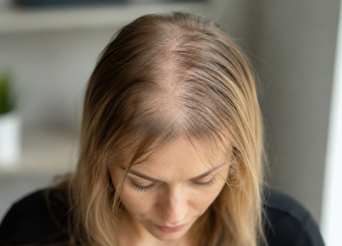 solution perte de cheveux