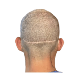 cicatrice tricopigmentation bordeaux