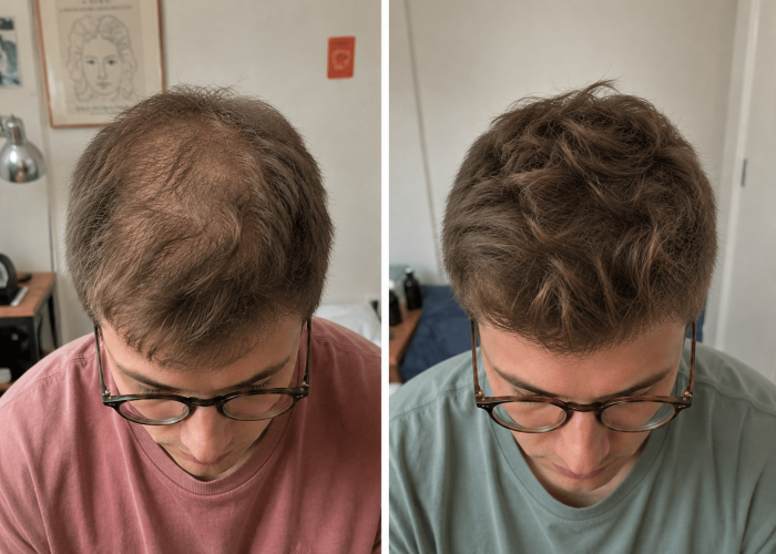 densification cheveux tricopigmentation