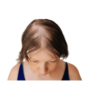 solution perte de cheveux femme